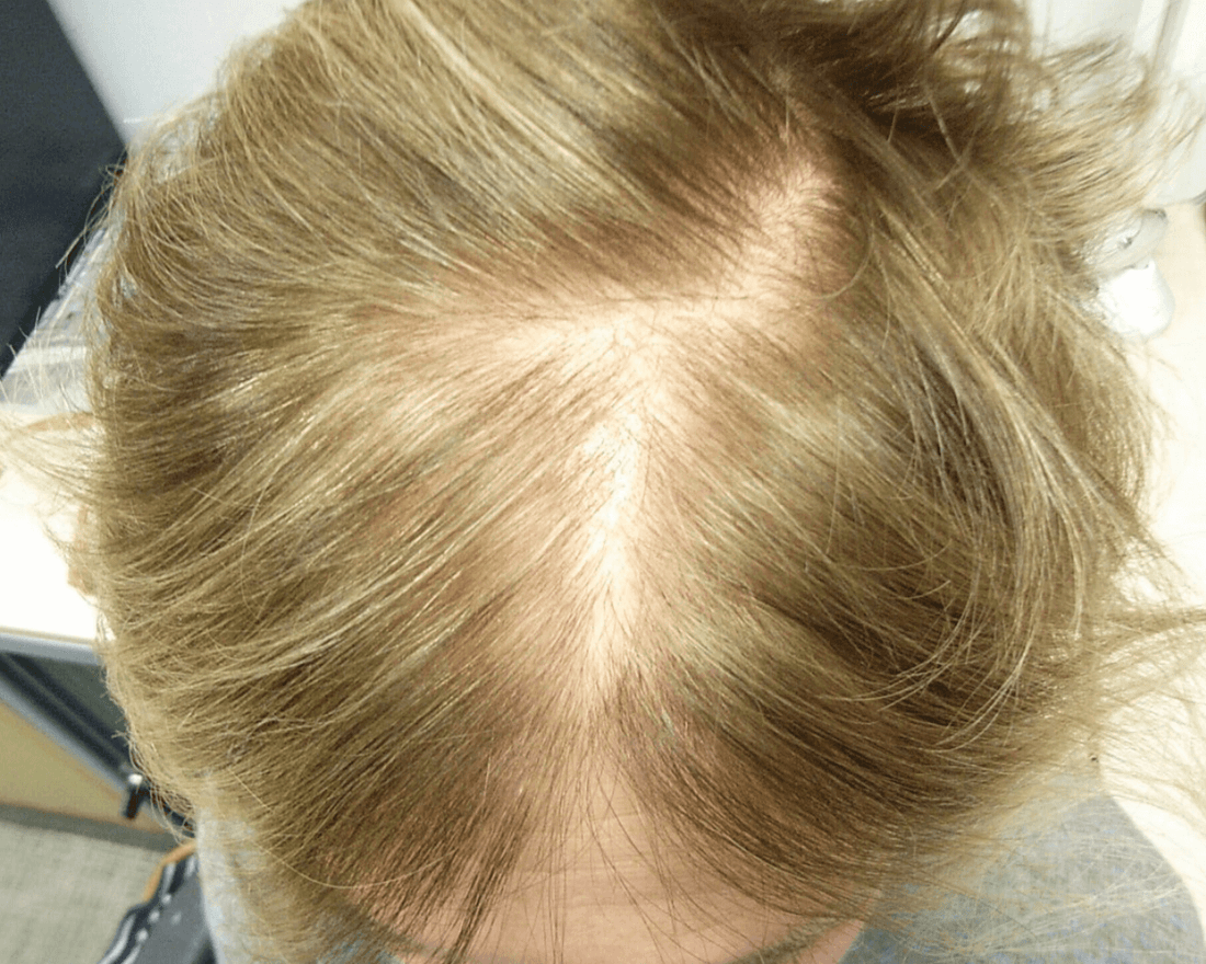 How to Thicken Hair That Is Thinning With Age