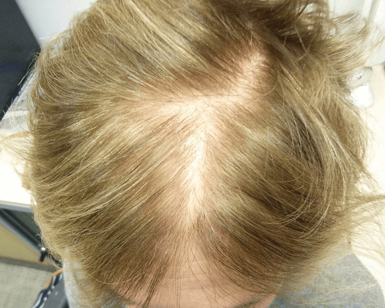 How to Thicken Hair That Is Thinning With Age