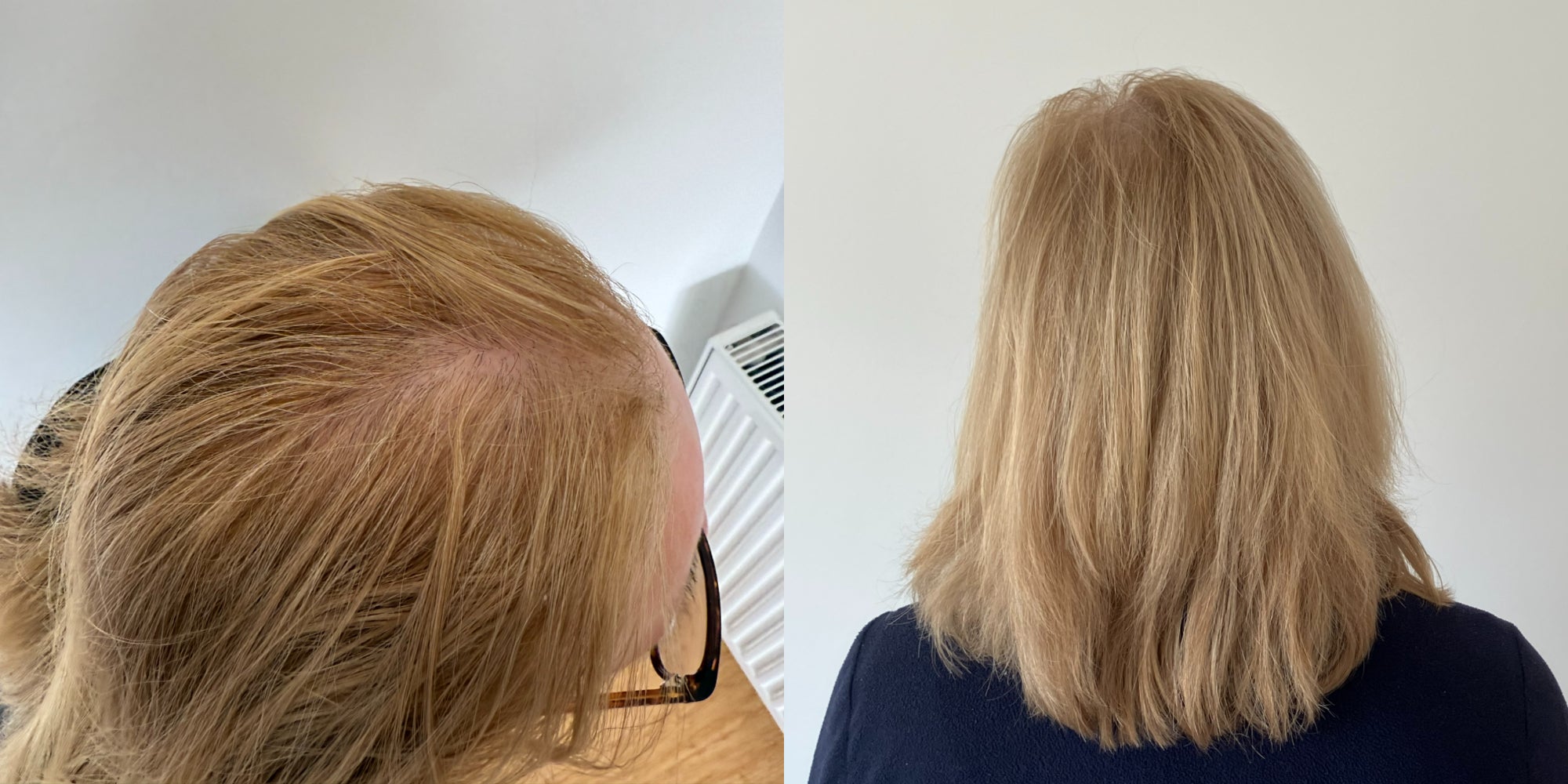 woman-reduces-hormonal-menopause-hair-thinning